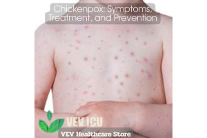 Chickenpox: Symptoms, Treatment, and Prevention