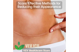 Say Goodbye to Scars: Effective Methods for Reducing their Appearance