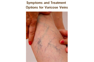 Symptoms and Treatment Options for Varicose Veins