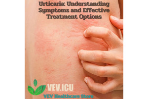 Urticaria: Understanding Symptoms and Effective Treatment Options