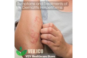 Symptoms and Treatments of Dermatitis Herpetiformis