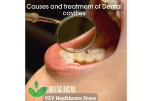 Causes and treatment of Dental cavities