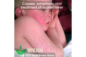 Causes, symptoms and treatment of scarlet fever1