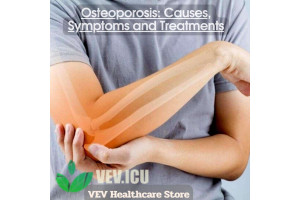Osteoporosis: Causes, Symptoms and Treatments