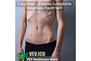 Cachexia - Causes Symptoms Diagnosis Treatment
