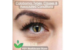 Coloboma: Types, Causes & Associated Conditions