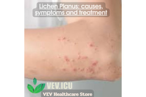 Lichen Planus: causes, symptoms and treatment