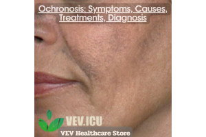 Ochronosis: Symptoms, Causes, Treatments, Diagnosis