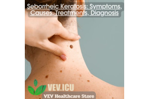 Seborrheic Keratosis: Symptoms, Causes, Treatments, Diagnosis