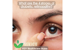 What are the 4 stages of diabetic retinopathy?