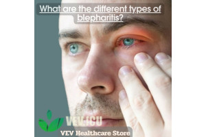 What are the different types of blepharitis?