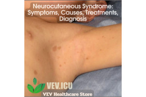 Neurocutaneous Syndrome: Symptoms, Causes, Treatments, Diagnosis