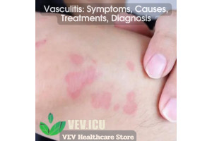 Vasculitis: Symptoms, Causes, Treatments, Diagnosis