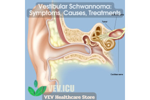 Vestibular Schwannoma: Symptoms, Causes, Treatments