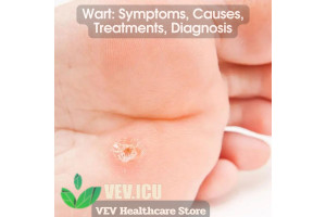 Wart: Symptoms, Causes, Treatments, Diagnosis