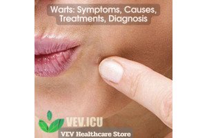 Warts: Symptoms, Causes, Treatments, Diagnosis