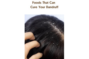 Foods That Can Cure Your Dandruff