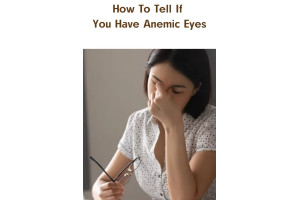 How To Tell If You Have Anemic Eyes 