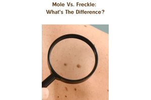 Mole Vs. Freckle: What's The Difference?