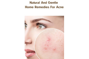 Natural And Gentle Home Remedies For Acne