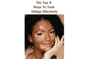 The Top 8 Ways To Treat Vitiligo Effectively