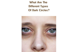 What Are The Different Types Of Dark Circles?