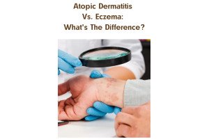 Atopic Dermatitis Vs. Eczema: What's The Difference?