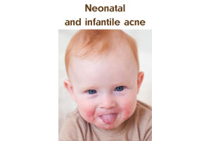 Neonatal and infantile acne - does it require treatment?
